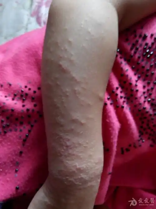 是湿疹还是接触性皮炎??? - 中医皮肤版 - 爱爱医医学论坛