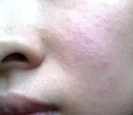 脸部皮肤使用化妆品过敏如何治