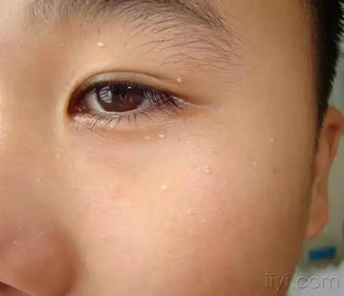 门诊图片2----------------------------------粟丘疹 - 皮肤及性传播