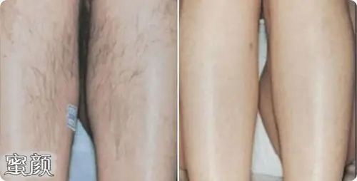 激光去除腿毛的价格大概需要多少呢?