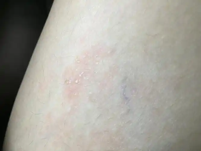 大腿上有毛毛的一小片