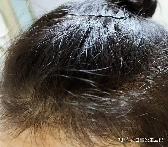 油性发质,而且掉头发,一般一天洗一次头发,用什么洗发水比较好?