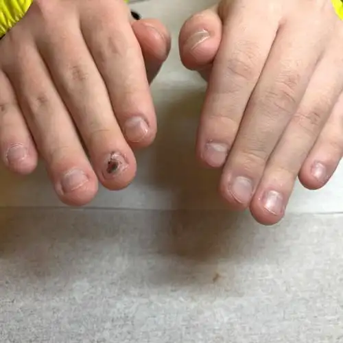 咬了10几年的指甲还有救吗