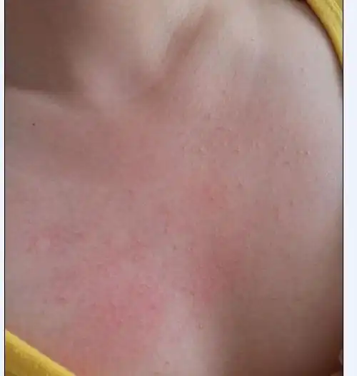 问:胸前长了一片像鸡皮疙瘩一样的小痘痘