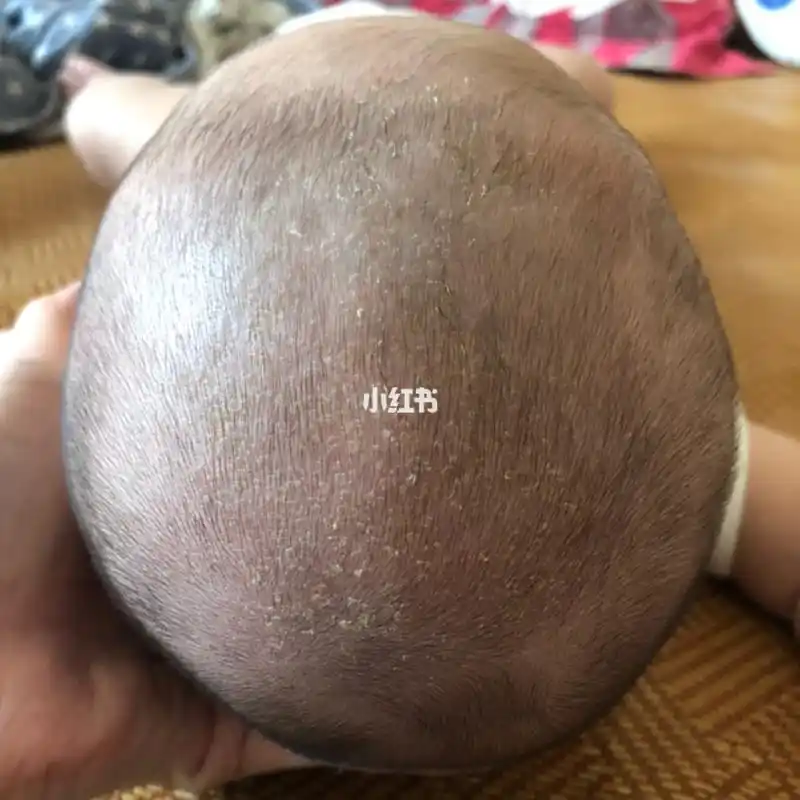 宝宝现在两个多月了,习惯平躺头一边侧,偏头了,后脑勺也有点上扁了