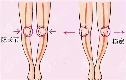 不同腿型示意图