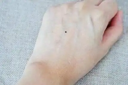 痣相手背有痣的人命好