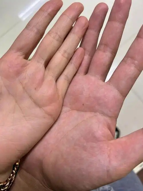 我找到了那个牵手掌心痣重叠在一起的那个人