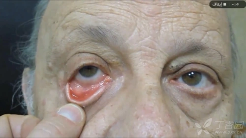 伴有眼睑水平松弛的退行性睑外翻的处理原则