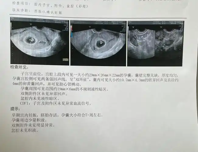 热乎乎的胎心胎芽,小老虎的玻璃心妈妈