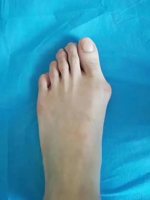 想做拇外翻手术,想知道年龄对于是否手术有影响吗想知道病龄对手术有