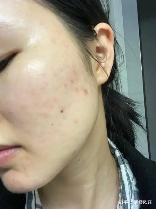 19岁的女生皮肤很差怎么办? - 知乎