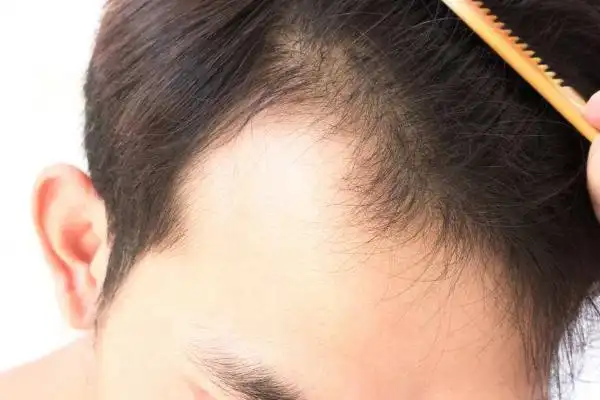 正常人发际线位置隔开这两个区域的发带缩窄毛