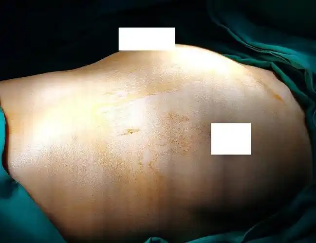 姐妹们谁有鸡胸从轻度到重度的图片?