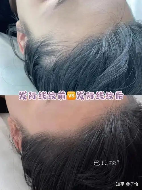 发际线高是什么体验发际线太高怎么办