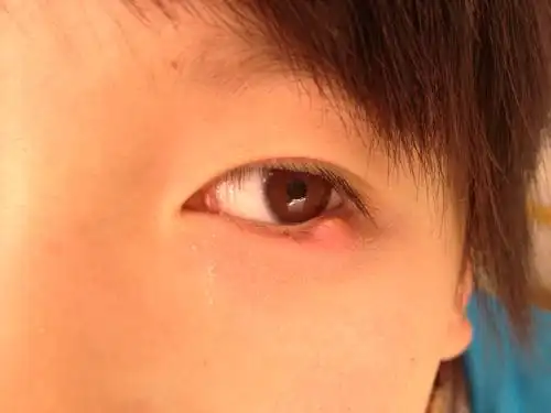 小孩下眼睑长了红疙瘩有白尖好像包脓了