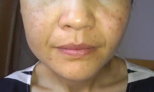 女性脸上长斑可由多种原因引起,总结起来至少有五大原因可以导致,具体