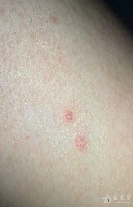 请帮看看什么皮肤病,不痛不痒 2个礼拜,背后胸前手臂都长有