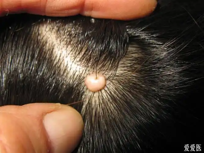 看图识病软纤维瘤