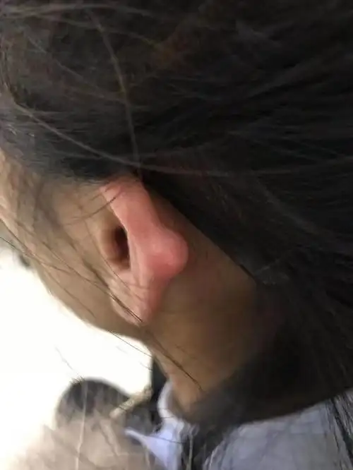 打耳洞竟然长出耳软骨瘤哈市五院医生创伤性美容要去医院