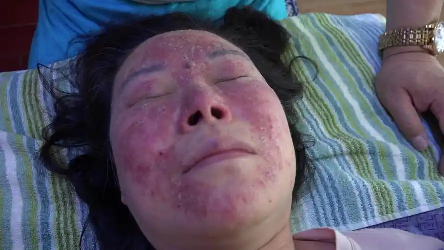 这是面部化妆品过敏第27次调理,第3次直接接触皮肤调理过程及效果,请