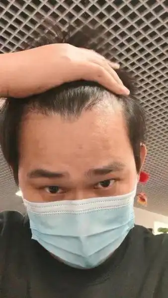 m型脱发,该怎么治疗?