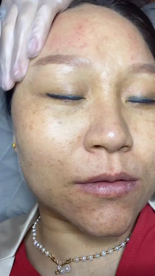 清远来的美女,好严重的色素问题,脸上皮肤暗黄粗糙,毛孔粗大,期待五