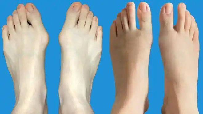 每个想做拇外翻的人都该看微创到底要不要选医生说出这4点