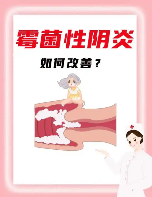 女性须知霉菌性阴炎日常应当如何护理