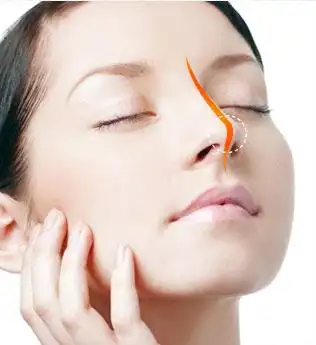 如果你是这些鼻子,不妨试试自体软骨隆鼻鼻梁塌:鼻梁没有明显的突出