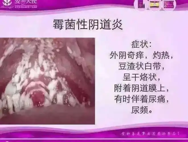 秀秀分享炎症反复无常