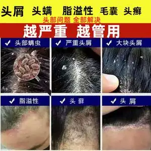 去头癣治疗头部牛皮藓头皮屑真菌感染洗发水毛炎银囊屑病止痒药膏