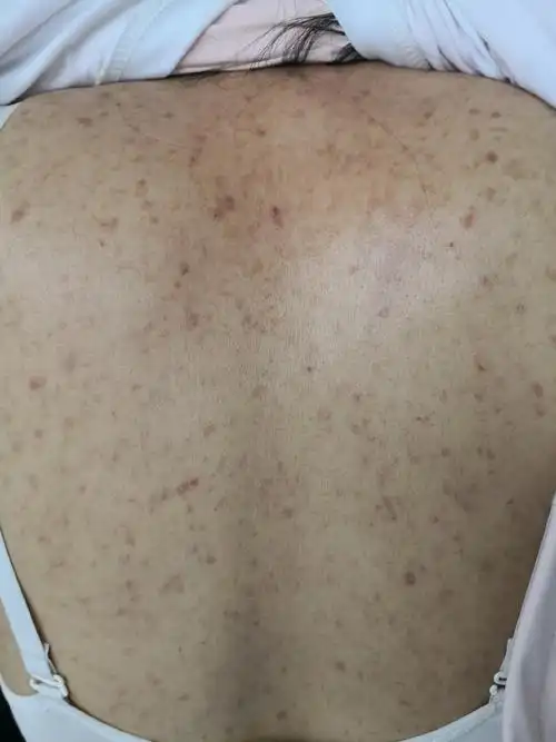 解决皮肤问题专注皮肤美容##毛囊炎