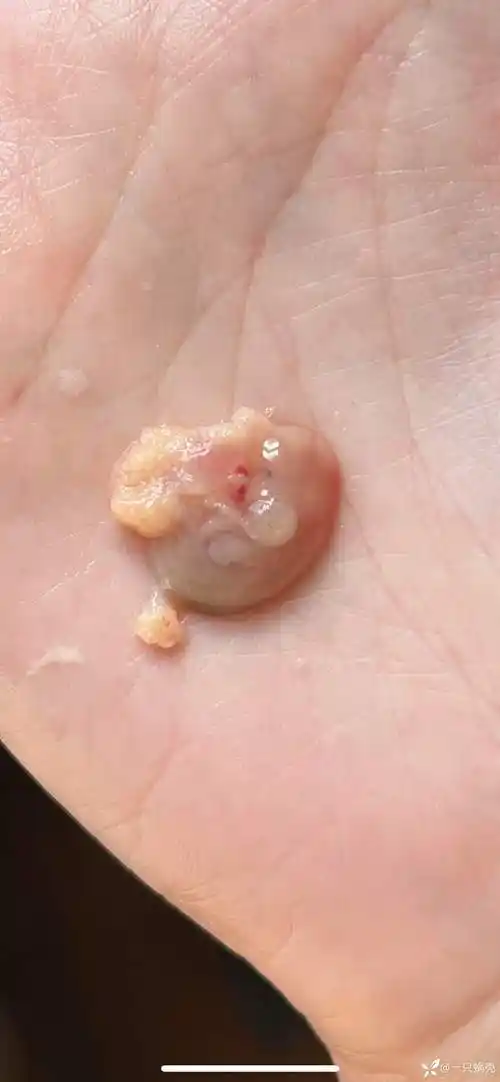 非常罕见710周流产的宝宝在手掌上的病例图