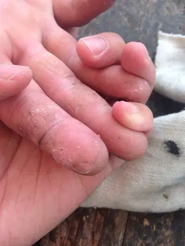 问:手上这样掉皮是怎么回事