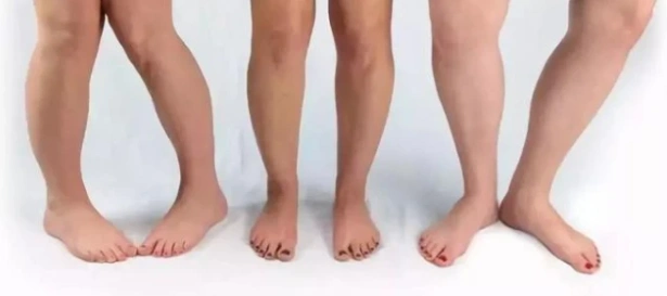 孩子形成八字脚走路姿势,应及时干预定制矫正鞋