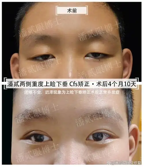 天生重度上睑下垂,提上睑肌无力,睁眼无力