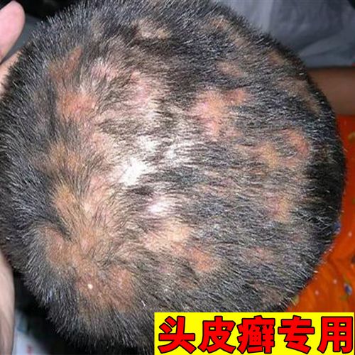 头皮癣专用头癣药膏治疗头部头癣银屑癣头皮痒洗发水药脂溢性皮炎