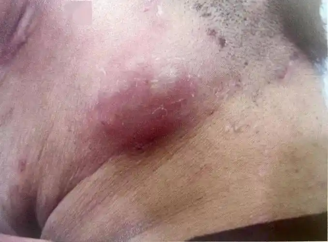 毛囊炎有很多「变化」:影响皮肤深部与周围叫疖,很多毛囊肿成一大块叫