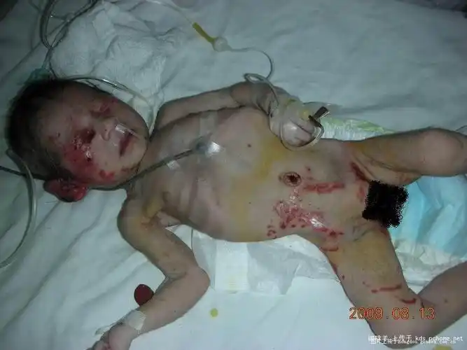 柳州一女婴刚出生被弃荒野 被发现时身上爬满蛆虫