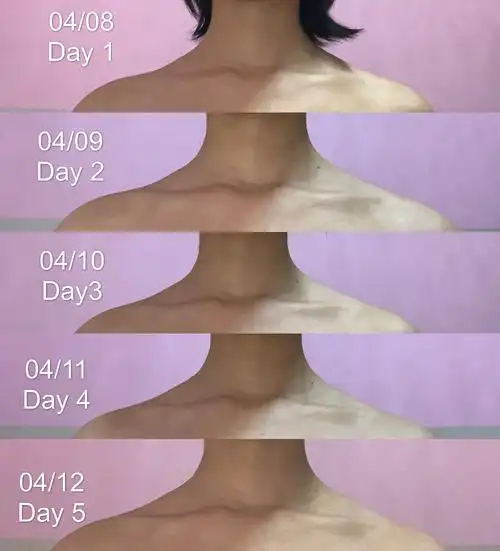 周六野斜方肌的5天我哭辽