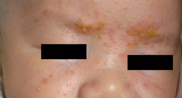 发生于20%新生儿,容易误诊为"婴儿湿疹",也容易混淆为"婴儿脂溢性皮炎