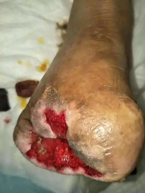 儿子带其就诊协和,301医院均予以截肢,儿子未放弃保留肢体的治疗,听患