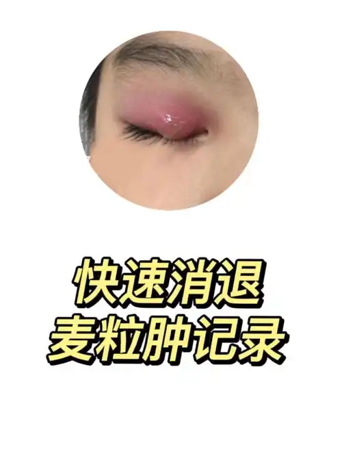 岁孩子麦粒肿涂什么药膏快速消肿攻略