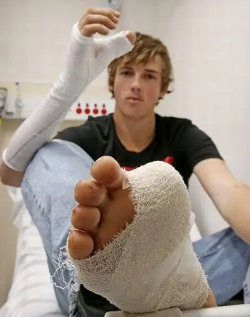 图片来源于网络 本想安装假指,医生称毫无意义,医生建议他将脚趾接到