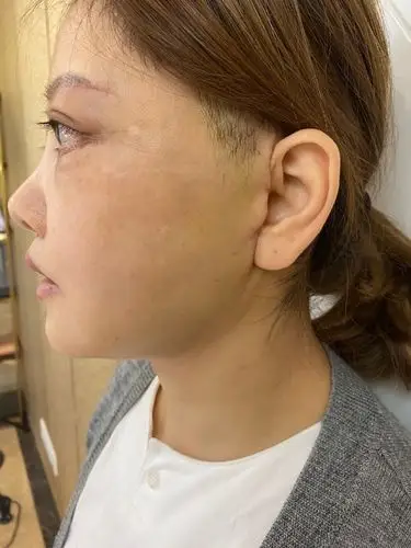 92迷你拉皮年轻化改善术后第二十五天92 94第二十五天_圈子