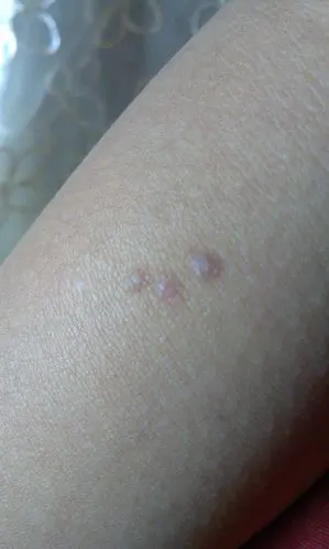 手臂上出现3个疙瘩,以前抓破了,愈合以后就变成这样了,有一年多了吧