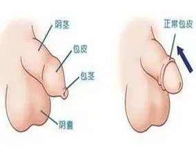 那么,小儿包茎的病因有哪些呢?为什么小孩就会出现这种情况呢?