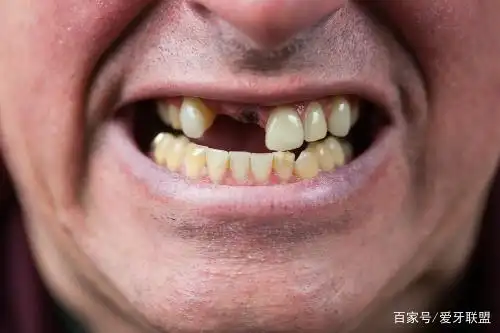 牙齿缺失不种植~千万美食都只如镜里看花!