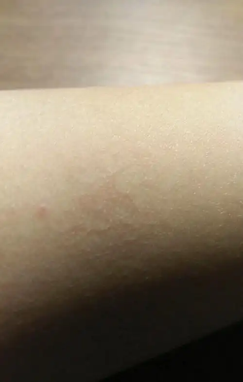 major snow这样一个普遍度极高的皮肤疾病,我们是否有合适的药膏来